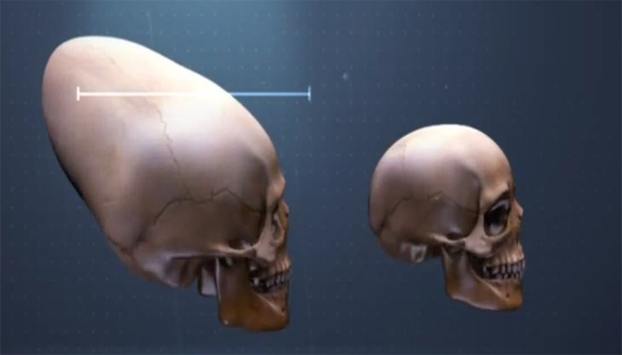 Cráneos alargados en Croacia ¿Evidencia extraterrestre?