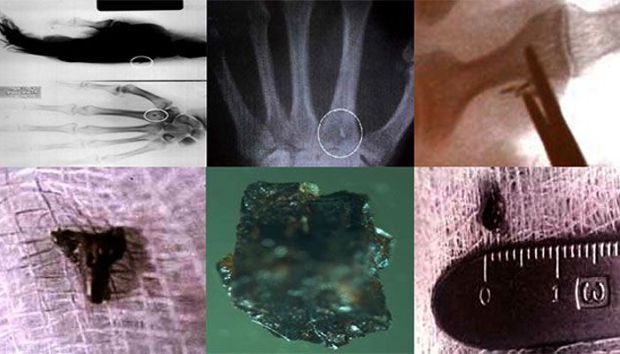 Implantes alienígenas: prova definitiva de abduções?
